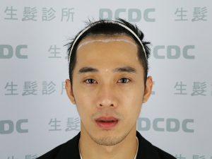 DCDC生髮診所男性髮際線植髮術前