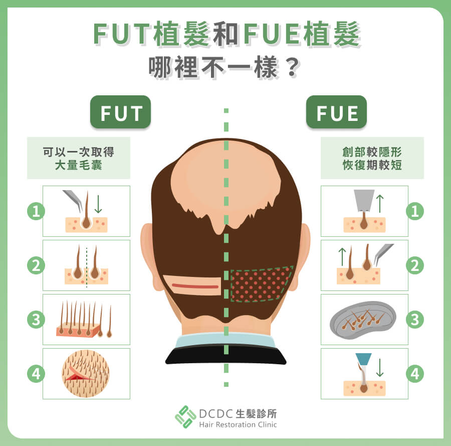 FUT 植髮和 FUE 植髮的不同 FUT植髮、FUE植髮的圖示