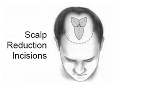 14 scalp reduction illustration