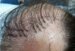 10 Hair-Transplant-Plugs-e1615409901675