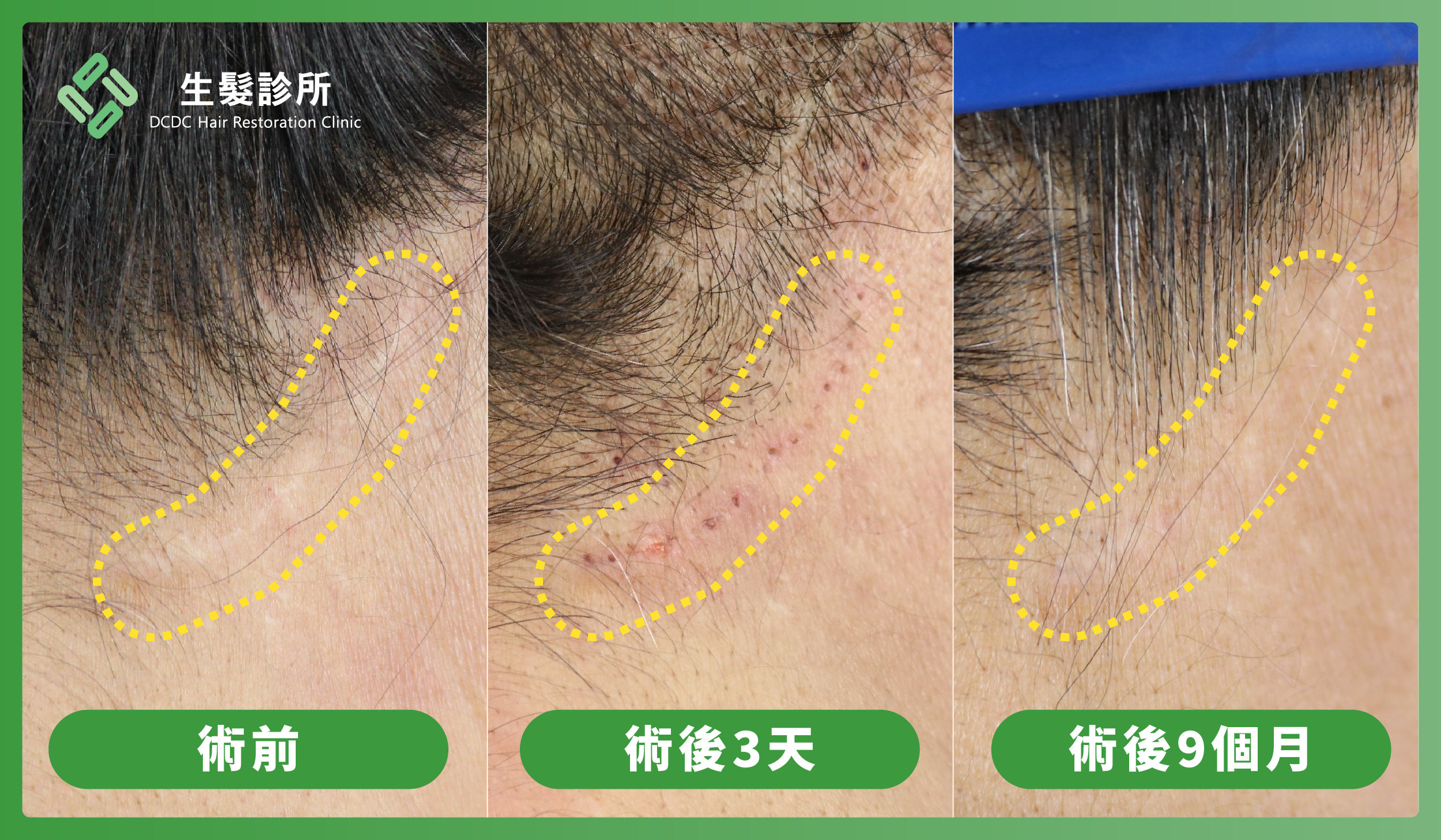 白疤案例1