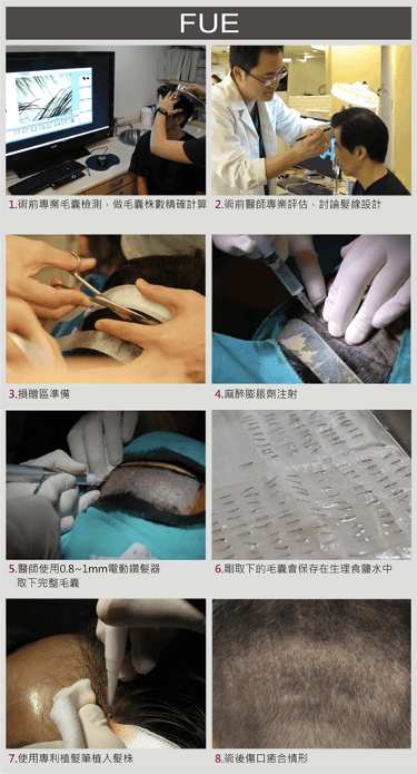 FUE手術流程