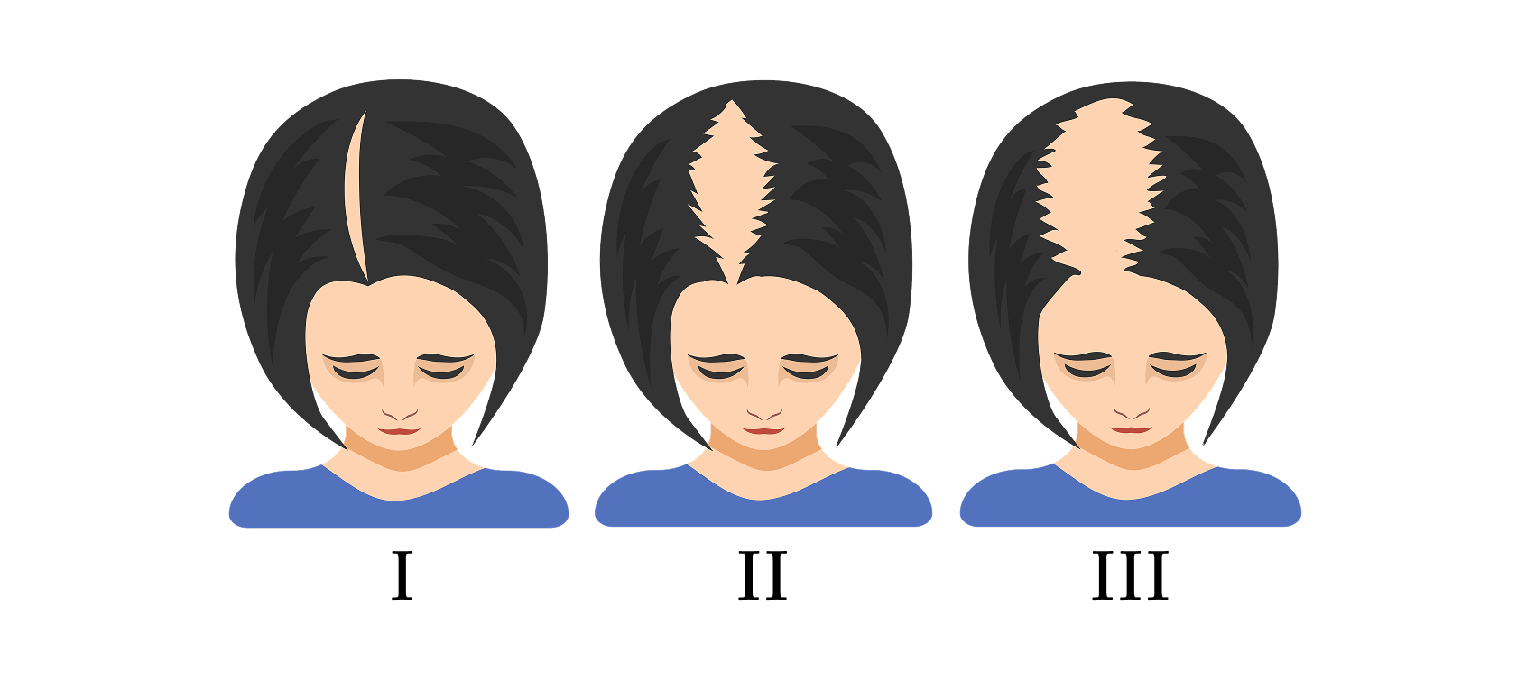 圖：Ludwig 女性型禿髮分級圖（正面）