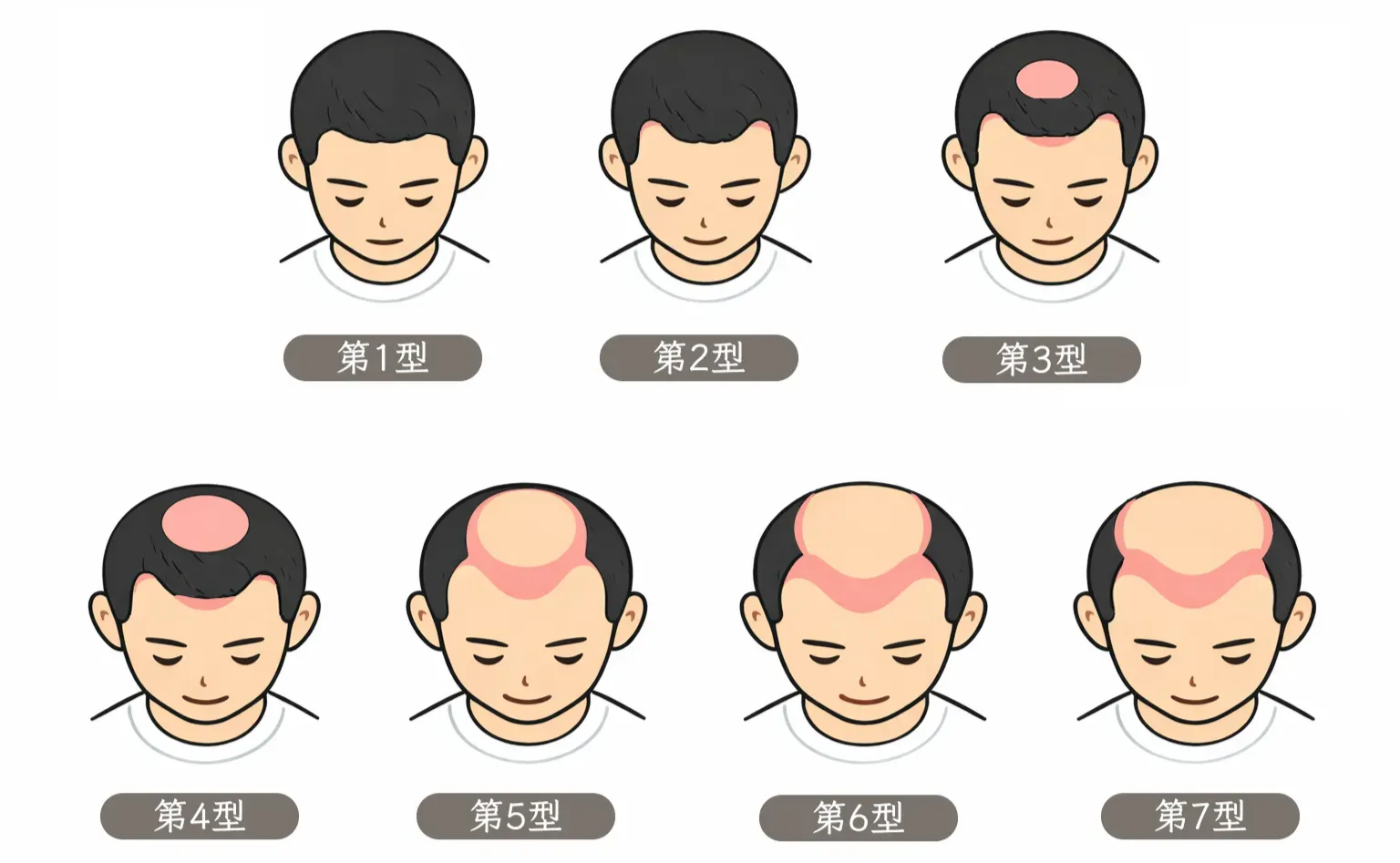 圖：Norwood 雄性禿分級圖（正面）