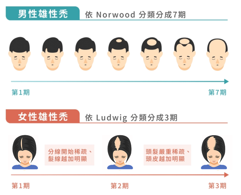 圖：雄性禿分類分期落髮進程示意圖