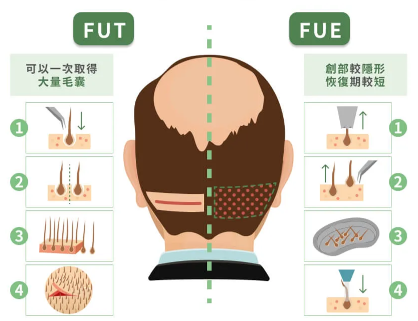 圖：FUT與FUE差異