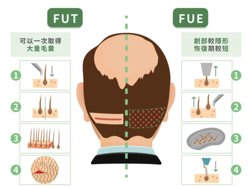 圖：FUT與FUE差異