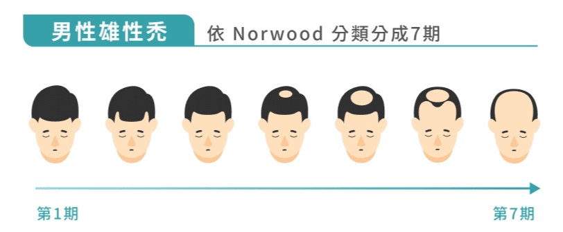 圖：Norwood 雄性禿分期示意圖
