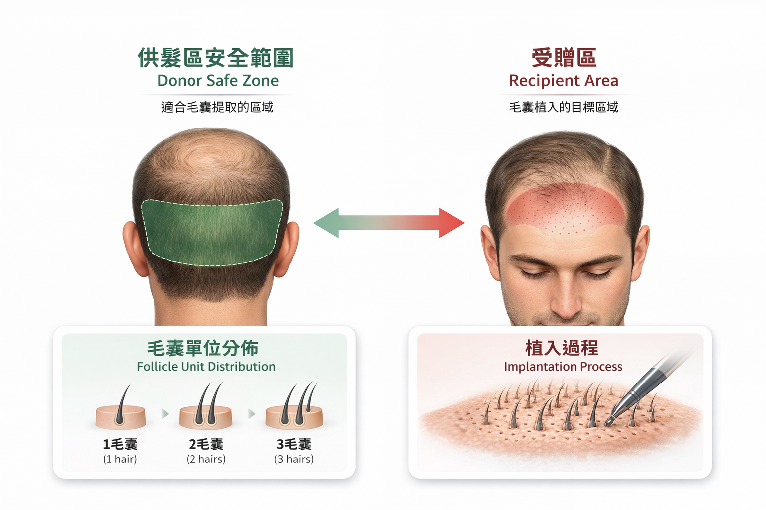 圖：安全供髮區與受贈區的毛囊分配概念示意圖