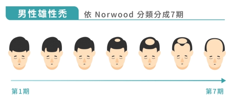 圖：男性雄性禿分類分期落髮進程示意圖