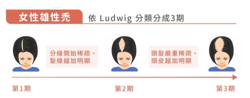 圖：女性雄性禿分類分期落髮進程示意圖