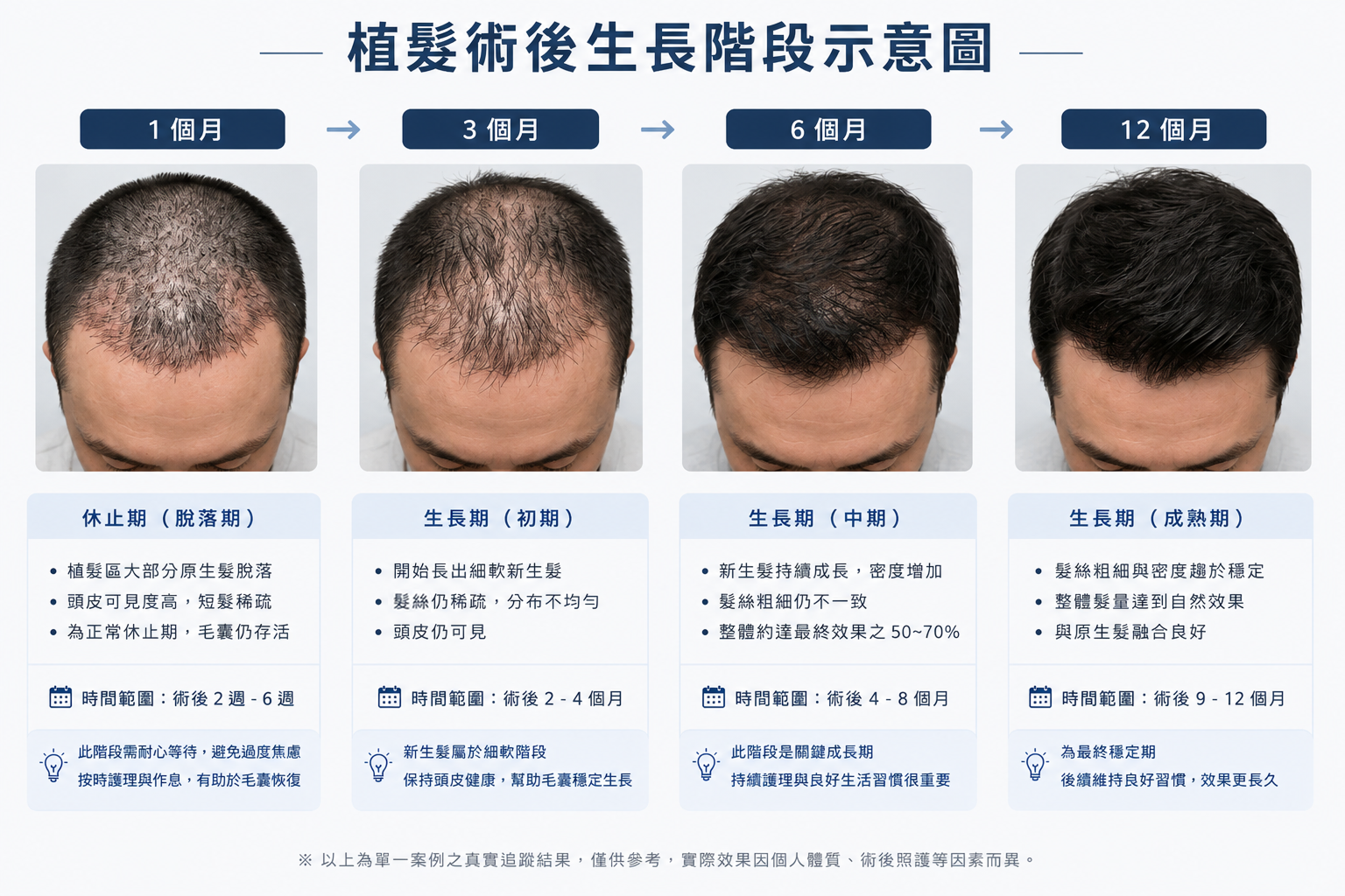 圖：植髮術後生長階段示意圖