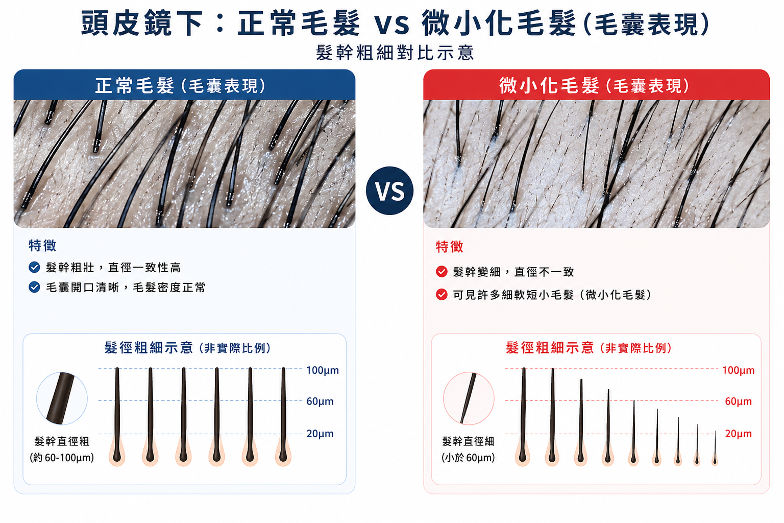圖：正常毛囊與微小化毛囊的髮幹粗細對比示意圖