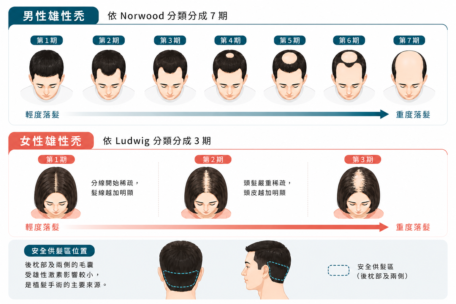 圖：雄性禿分類分期與安全供髮區示意圖