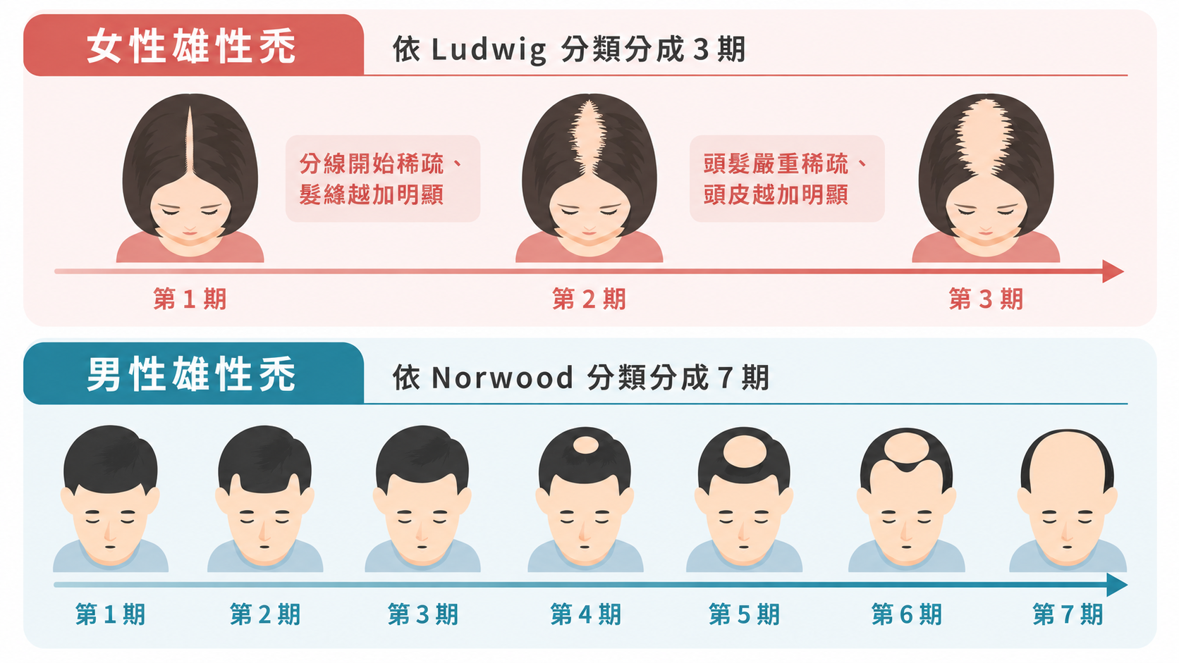 圖：男性與女性雄性禿分期示意圖